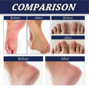 Instant Foot Peeling Spray Heel Scraper Corn Remover Callus And Dead Skin Remover For Feet Gentle Formula For Cracked