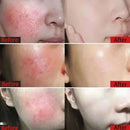 Facial Redness Repair Cream Sensitive Skin Dryness Moisturizer Hydrating Sooth Serum Lotion  Removal Rosacea Skin Care Ointments