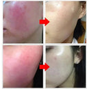Facial Redness Repair Cream Sensitive Skin Dryness Moisturizer Hydrating Sooth Serum Lotion  Removal Rosacea Skin Care Ointments