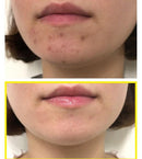 SOME BY MI Bye Bye Blackhead 30 Days Miracle Green Tea Tox Bubble Cleanser Pimple Acne Treatment Blackhead Removal Exfoliating